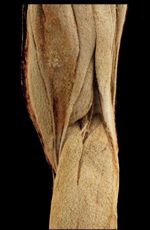 GSW with Bleed Near Knee - CTisus CT Scan