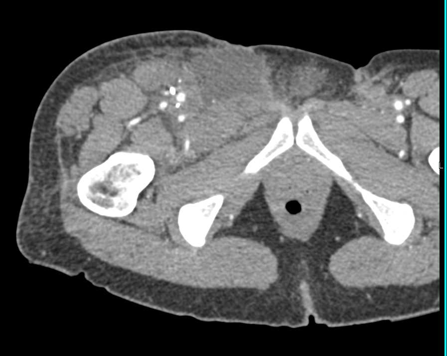 Induration Right Groin from IVDA - CTisus CT Scan