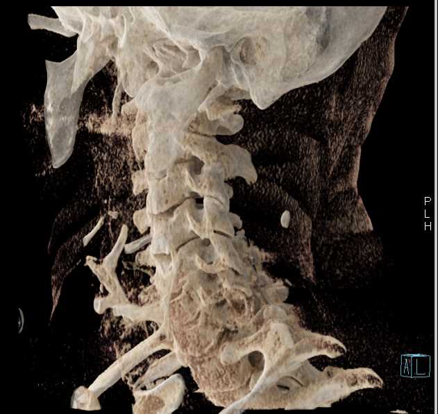Spinal Repair with Hardware - CTisus CT Scan