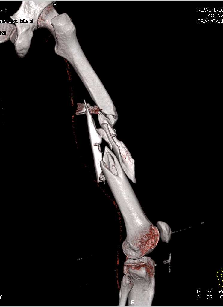 Comminuted Femur Fracture - CTisus CT Scan