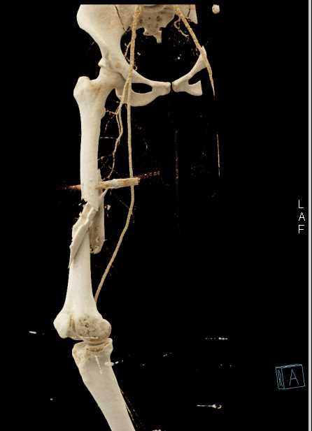 Comminuted Femur Fracture without Vascular Injury - CTisus CT Scan
