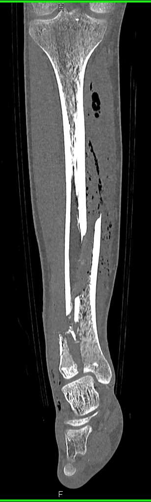 Spiral Fracture Tibia and fibula - CTisus CT Scan