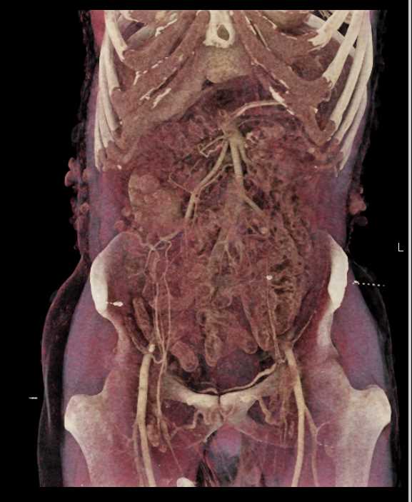 Neurofibromatosis - CTisus CT Scan