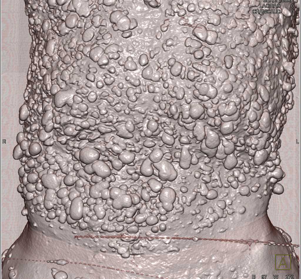 Neurofibromatosis with Small Bowel Tumors - CTisus CT Scan