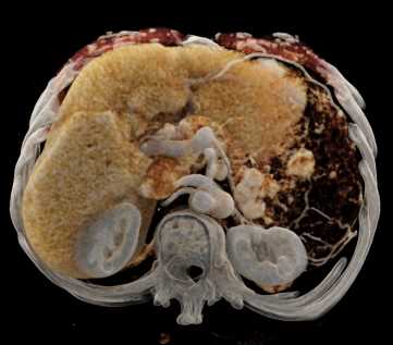 Neurofibromatosis with Small Bowel Tumors - CTisus CT Scan