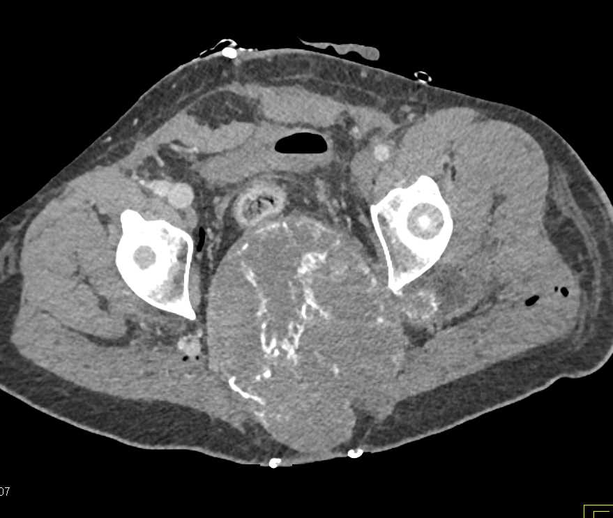 Sacral Chordoma - CTisus CT Scan