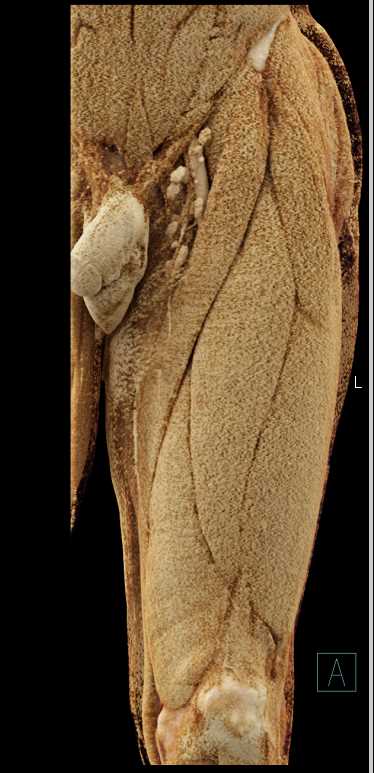 Thigh Hematoma - CTisus CT Scan