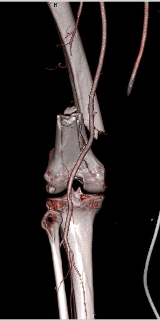 Complex Femur Fracture with Lipohemarthrosis - CTisus CT Scan