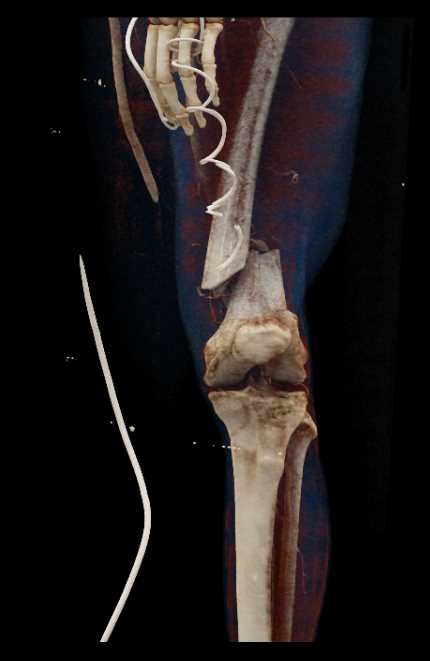 Complex Femur Fracture with Lipohemarthrosis - CTisus CT Scan