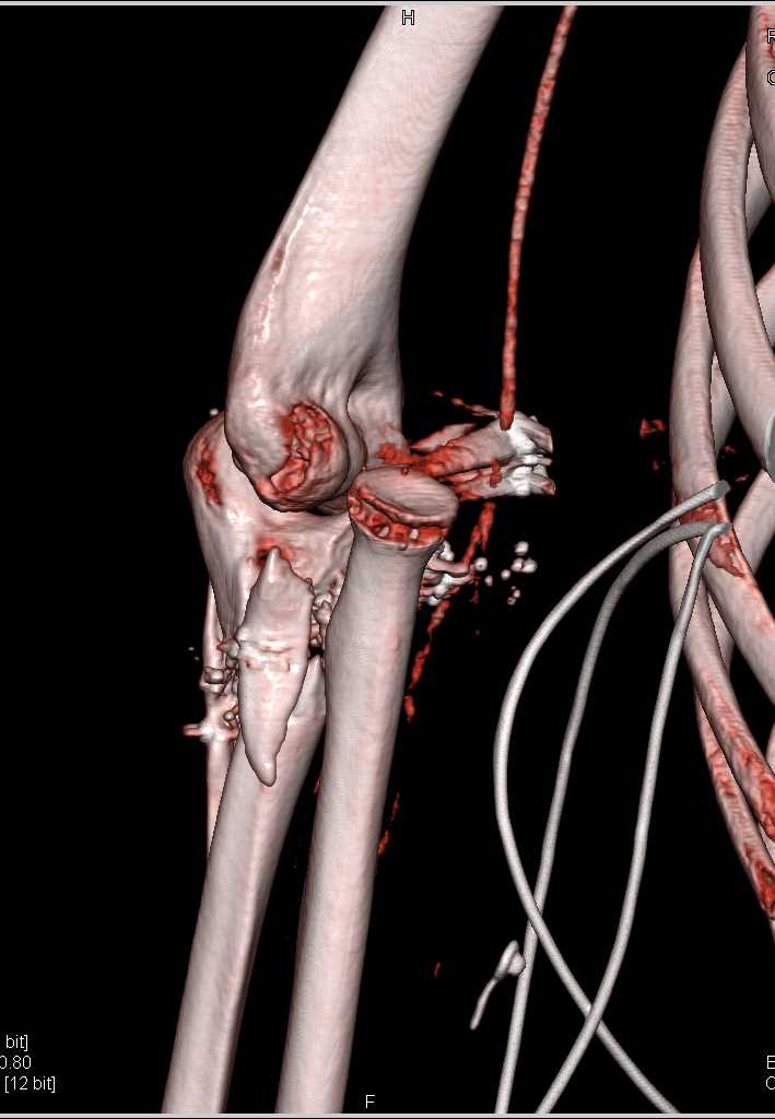 GSW Right Elbow with Fracture - CTisus CT Scan