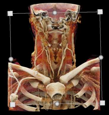 CR of the Neck with Vascular Mapping - CTisus CT Scan