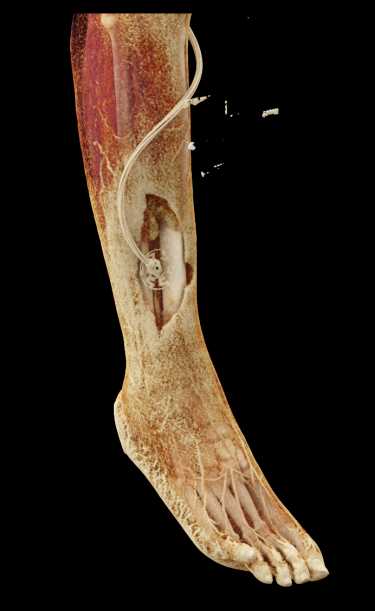 Ulceration Right Calf with Abscess - CTisus CT Scan