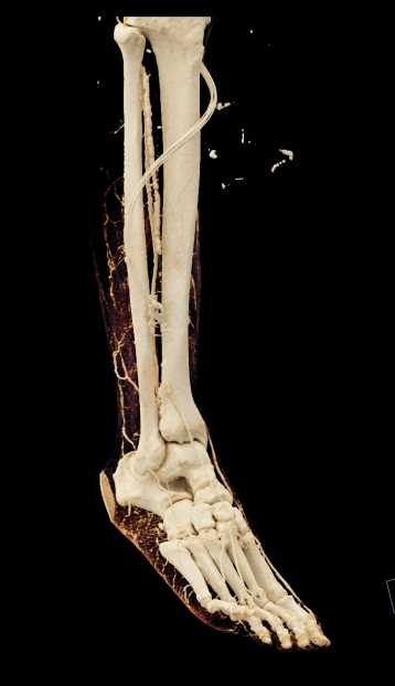 Ulceration Right Calf with Abscess - CTisus CT Scan