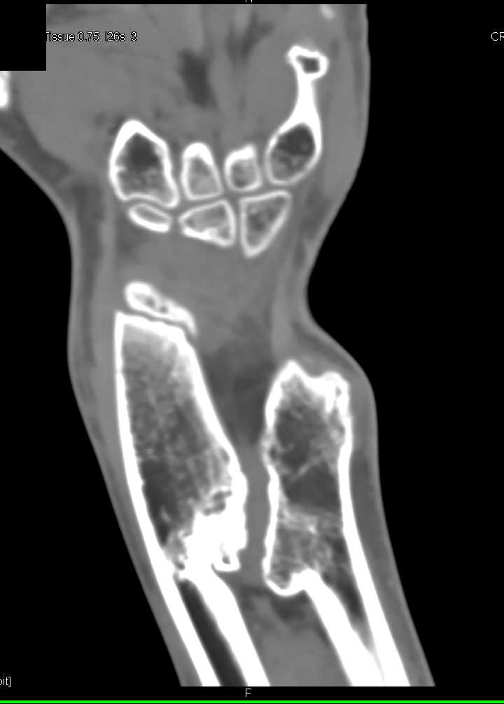 Remodeling of deformed Distal Radius and Ulna - CTisus CT Scan