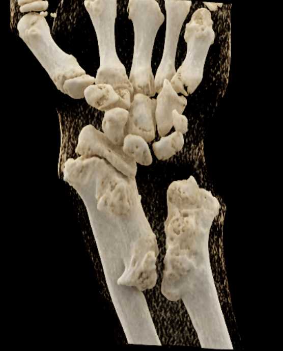 Remodeling of deformed Distal Radius and Ulna - CTisus CT Scan