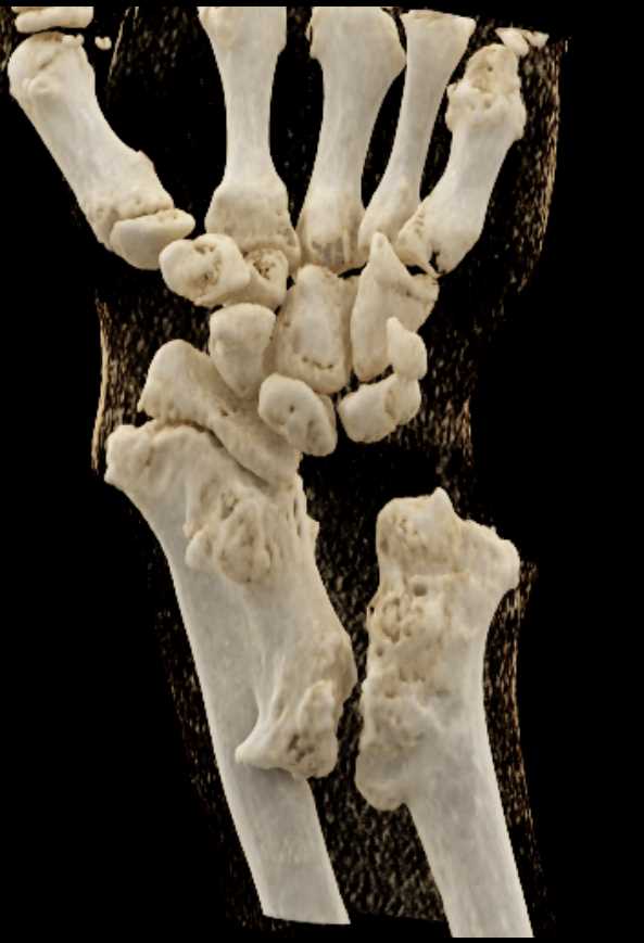Remodeling of deformed Distal Radius and Ulna - CTisus CT Scan
