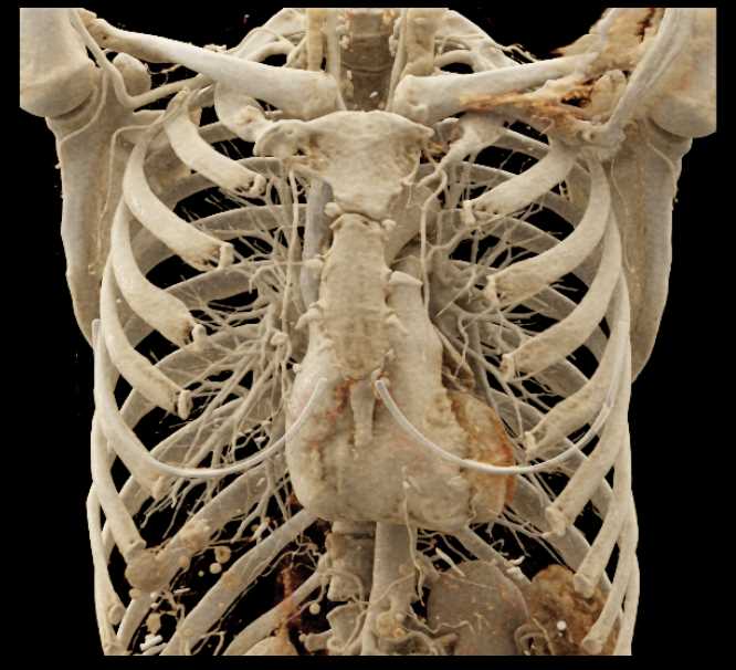 Cinematic Rendering of the Chest Wall - CTisus CT Scan