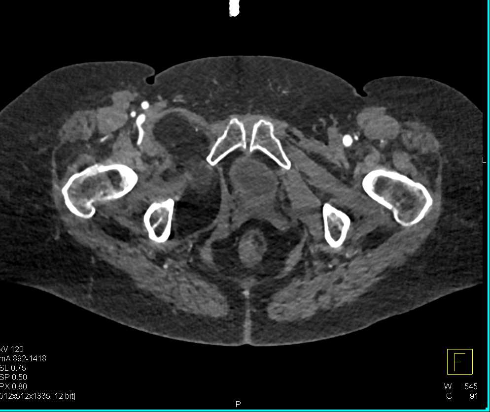 Lipoma Upper Right Thigh - CTisus CT Scan
