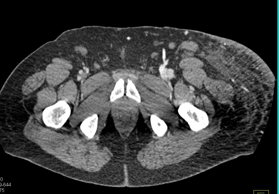 Lymphedema Left Thigh - CTisus CT Scan