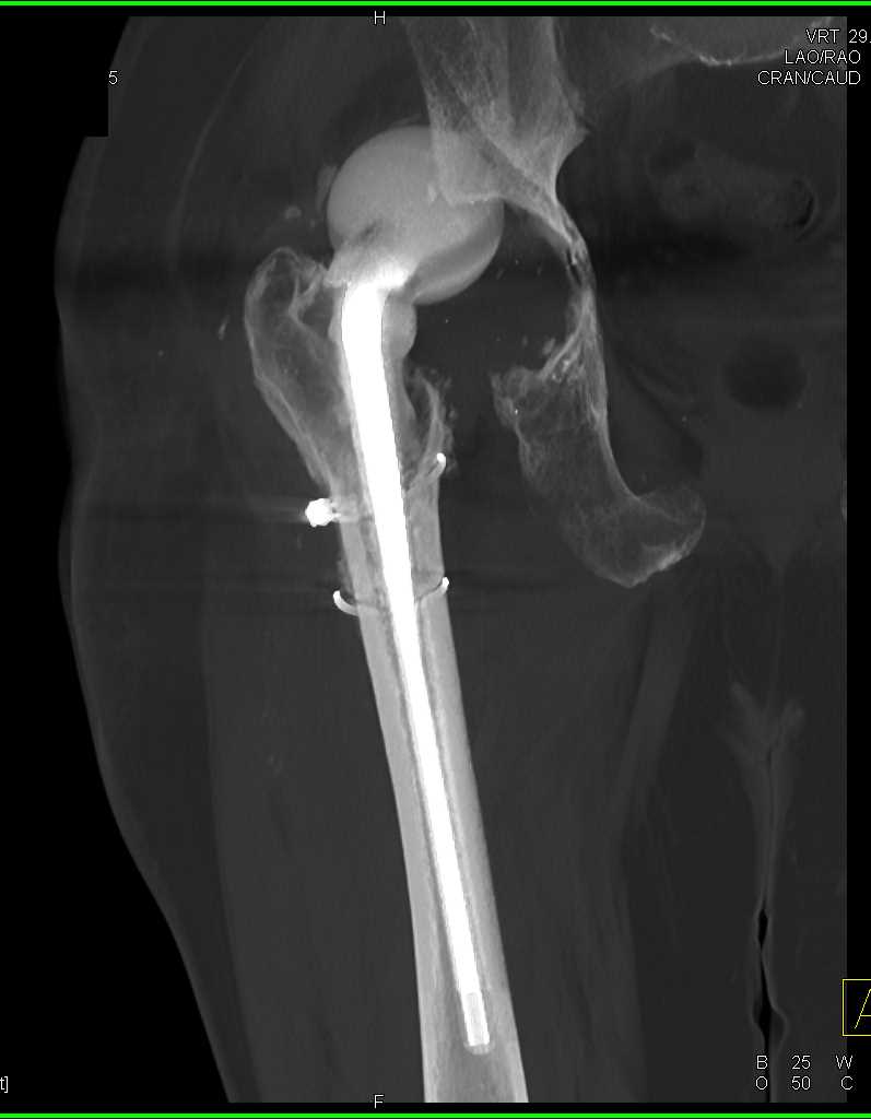 Dislocated Right Hip Prosthesis - CTisus CT Scan
