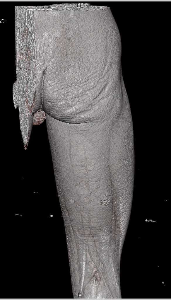 GSW Thigh seen on VRT - CTisus CT Scan