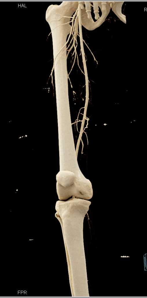 GSW Thigh seen on VRT - CTisus CT Scan