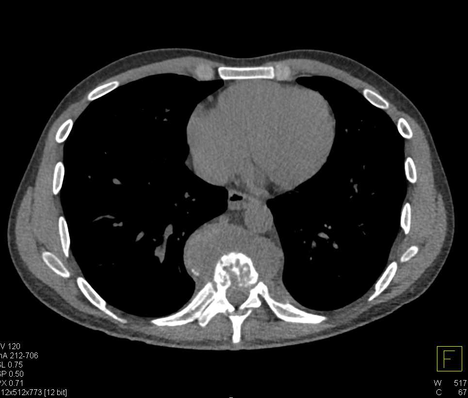 Pott's Disease Spine - CTisus CT Scan
