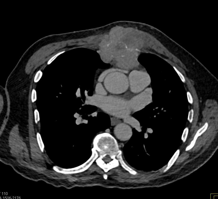 Plasmacytoma - CTisus CT Scan