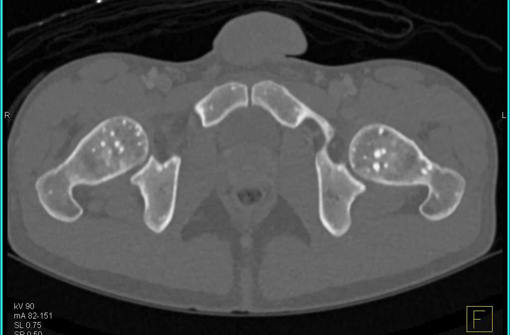 Osteopoikilosis - CTisus CT Scan