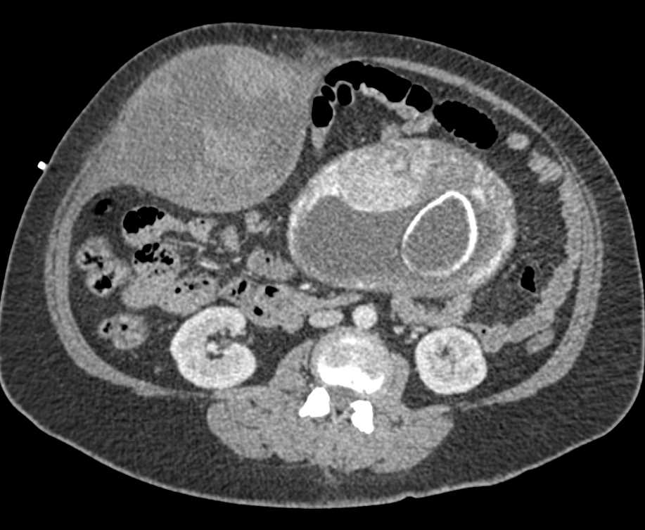 CTisus CT Scanning | Rectus Sheath Hematoma in a Pregnant Patient