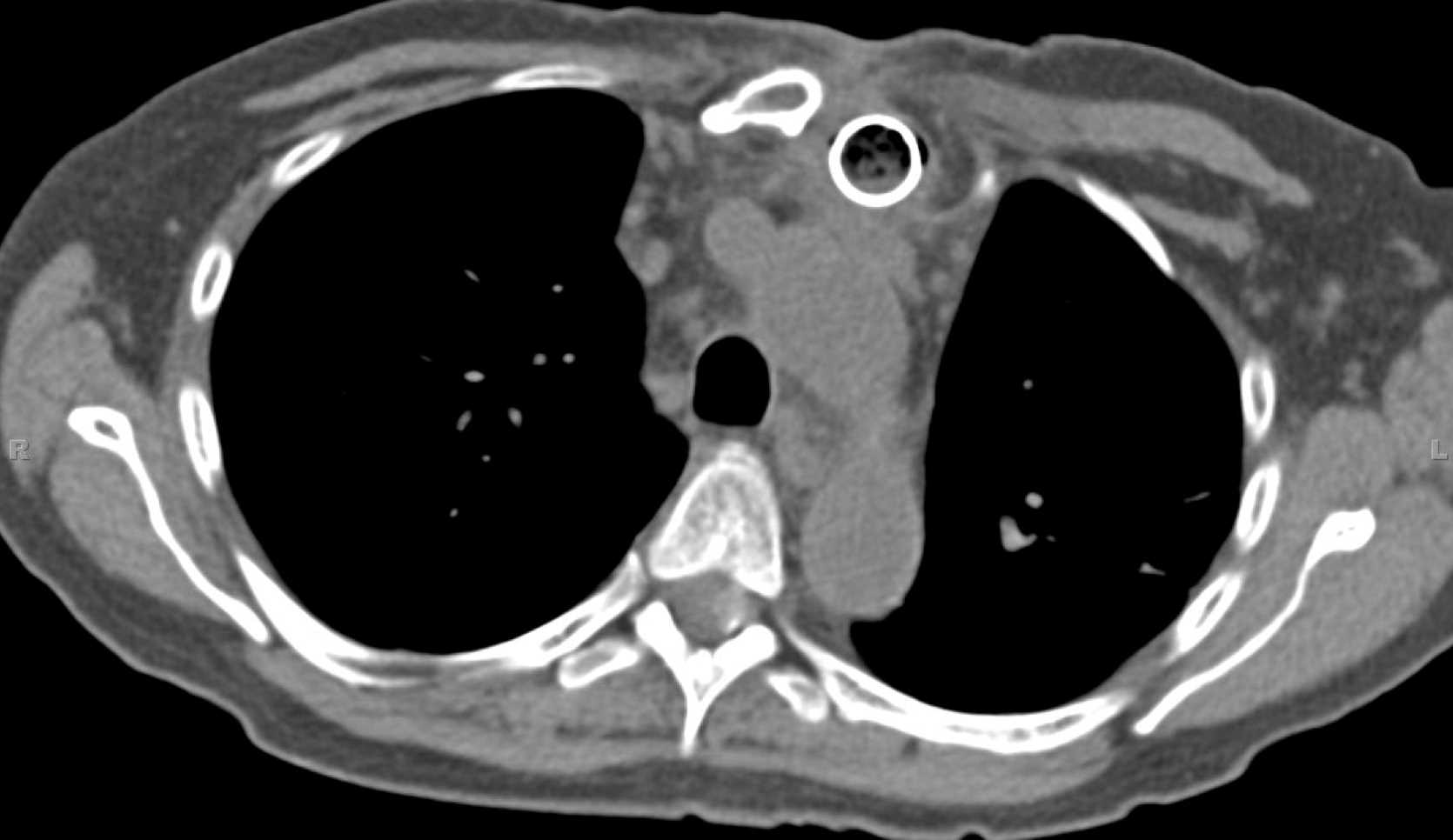 Meningioma T6 Spinal Canal - CTisus CT Scan