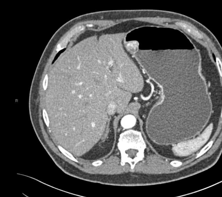 Glomus Tumor - CTisus CT Scan