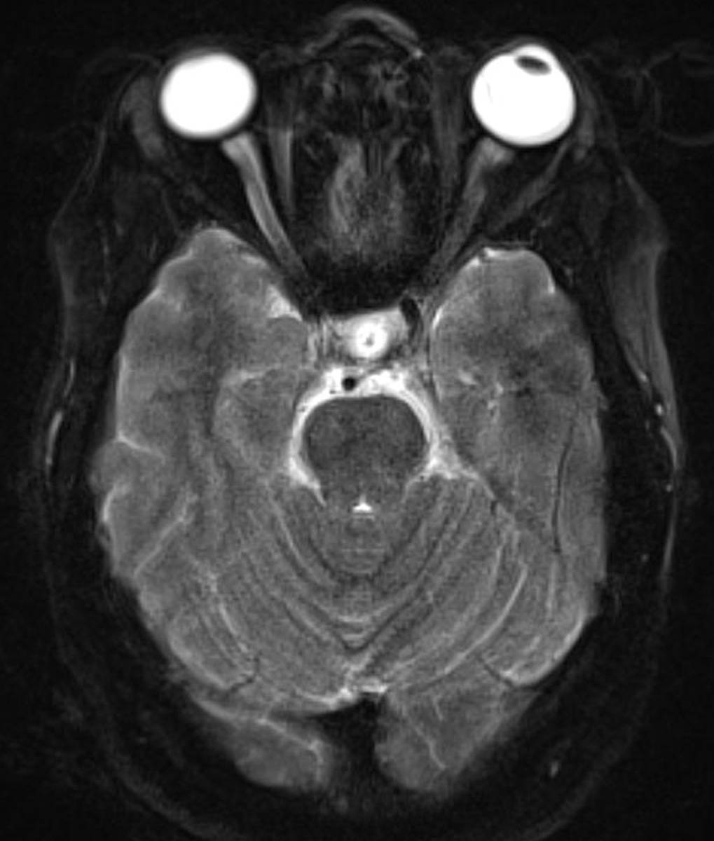 Congenital Absence ICA. - CTisus CT Scan