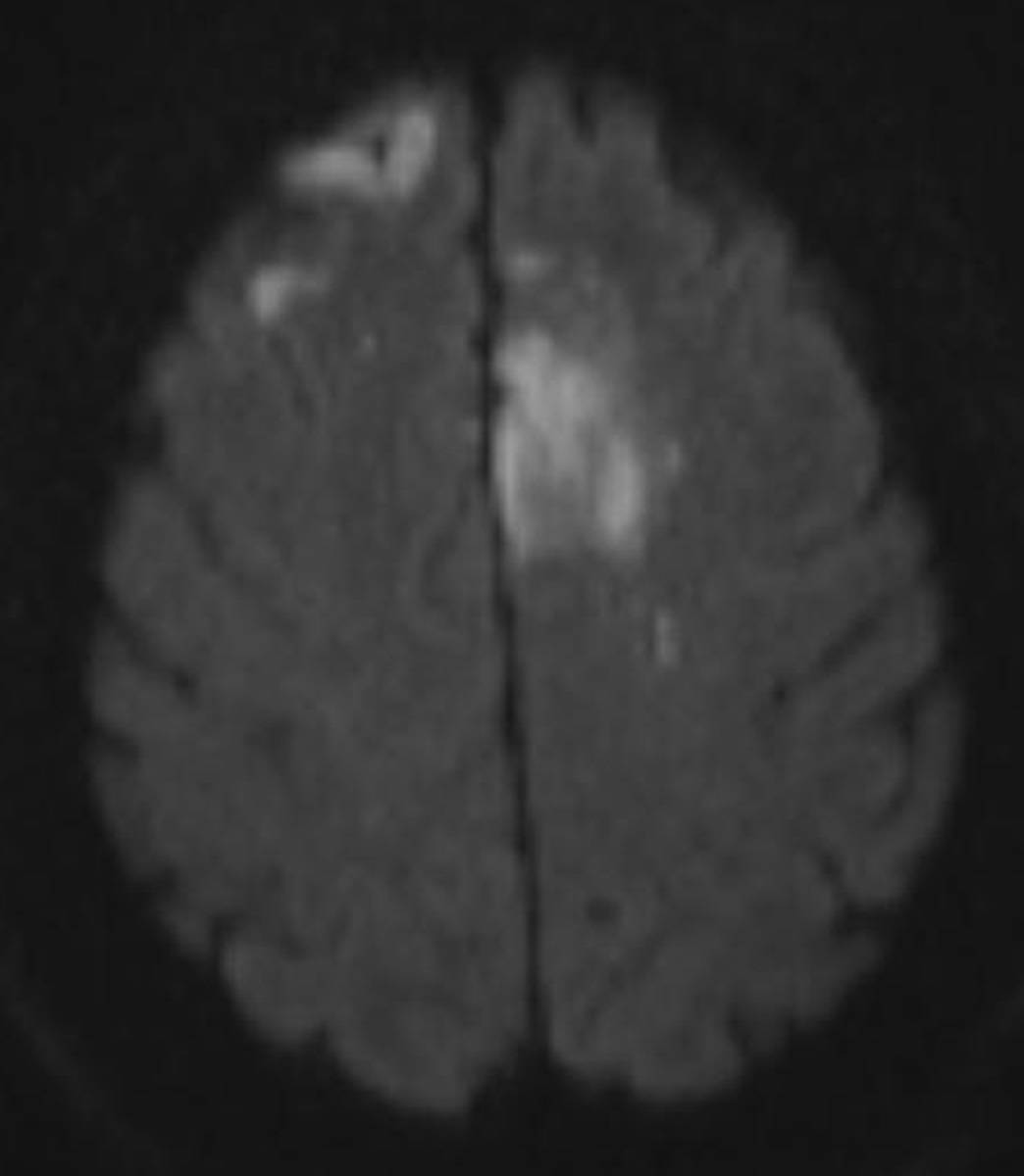 Embolic Infarctions. - CTisus CT Scan
