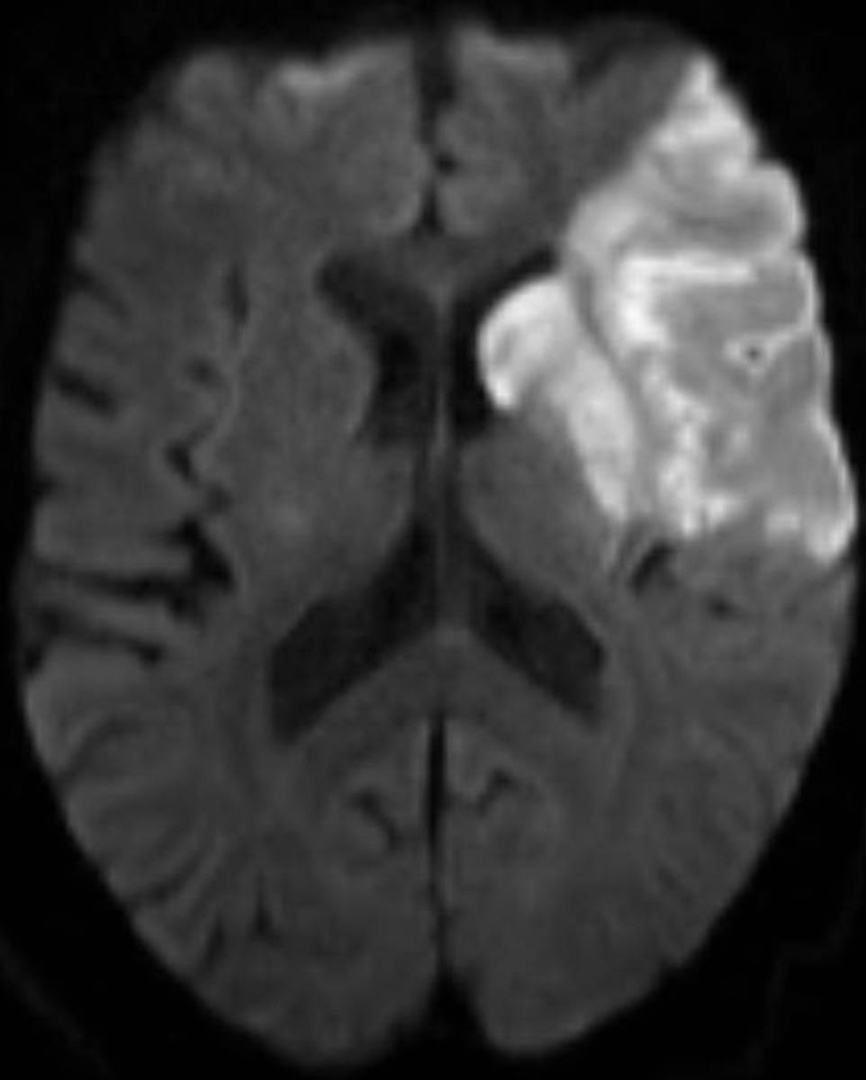 Left MCA Stroke. - CTisus CT Scan