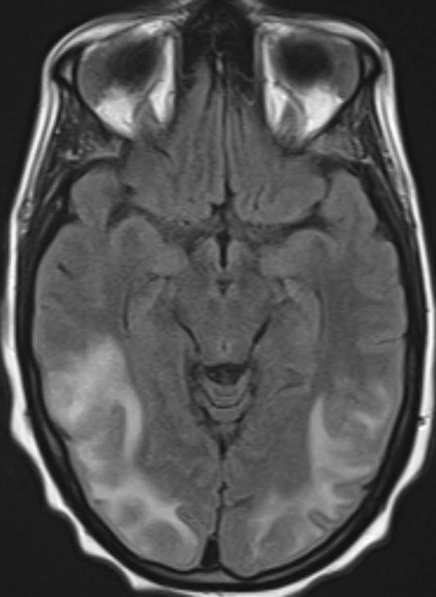 Posterior Reversible Encephalopathy Syndrome. - CTisus CT Scan