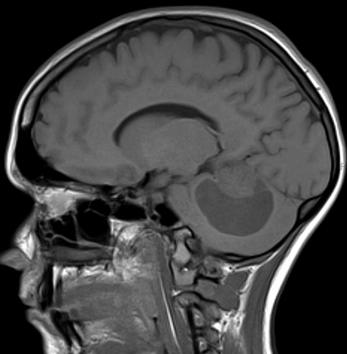 Pilocytic Astrocytoma - CTisus CT Scan