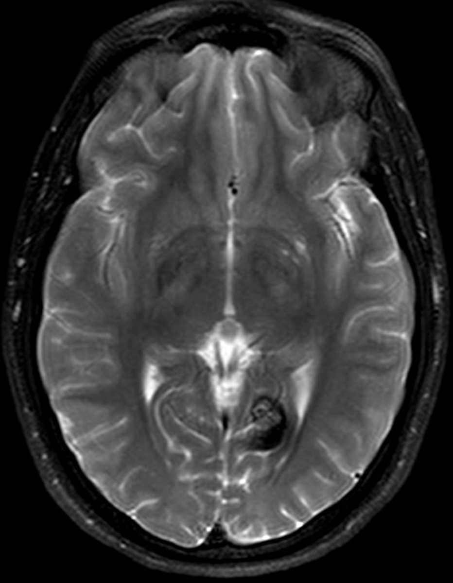 Cavernoma - CTisus CT Scan