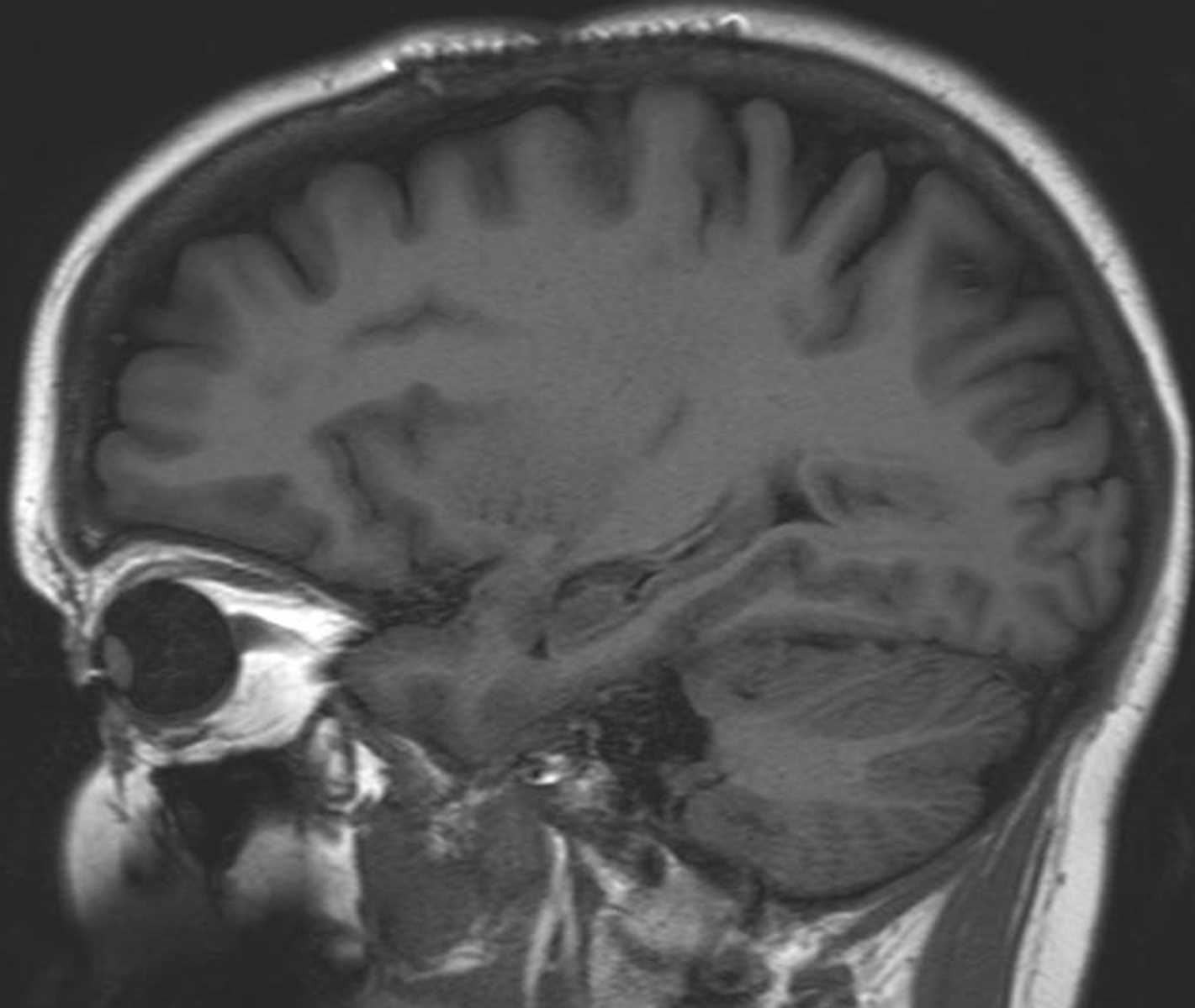 Dural AVF - CTisus CT Scan