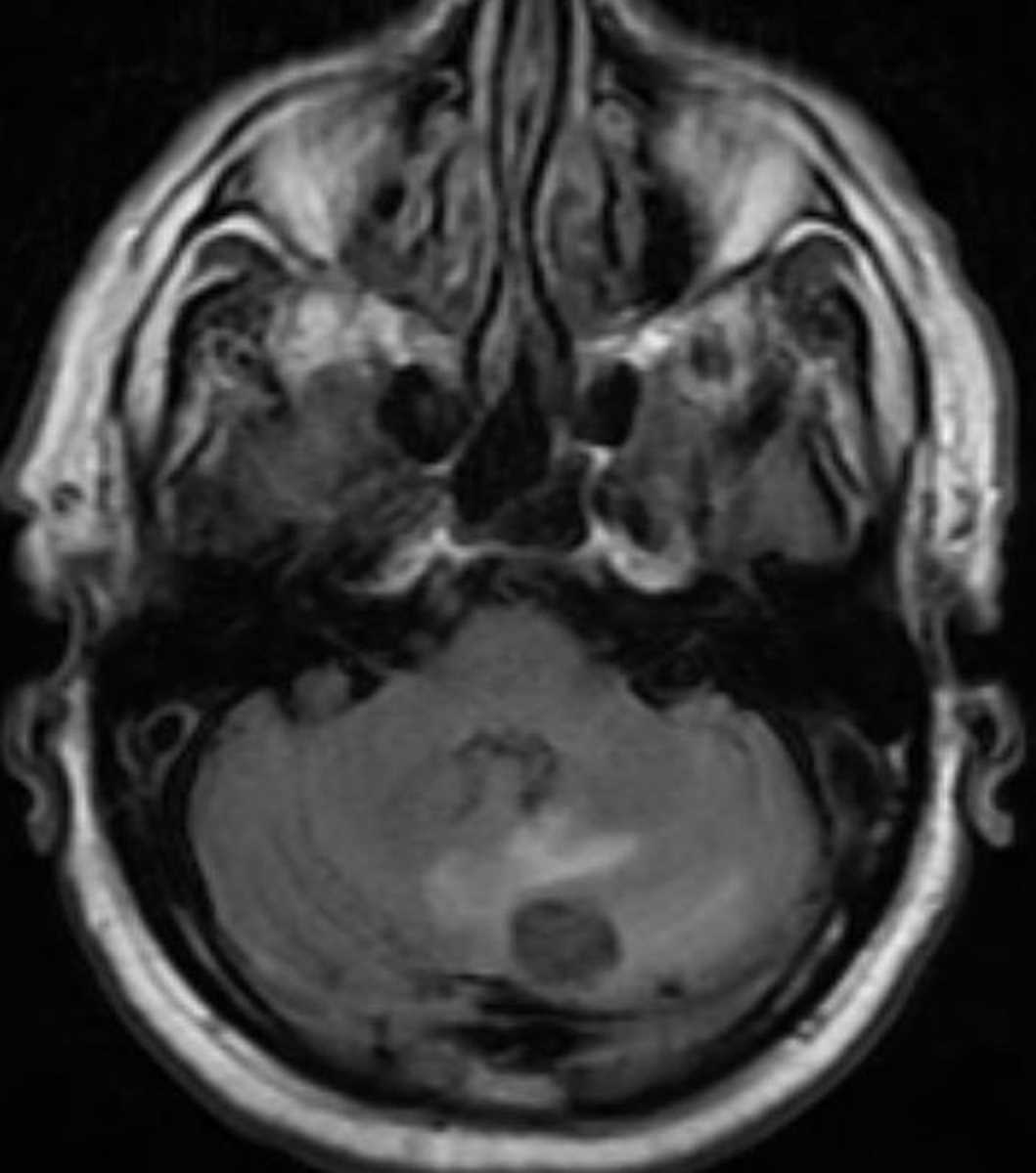 Metastases-Colon Cancer - CTisus CT Scan