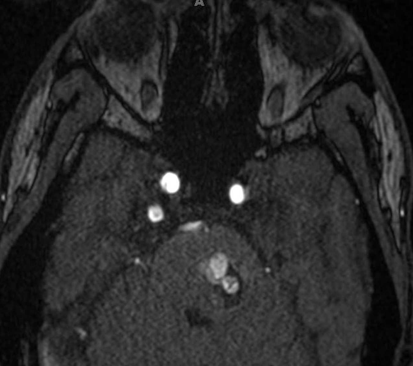 Persistent Trigeminal Artery - CTisus CT Scan