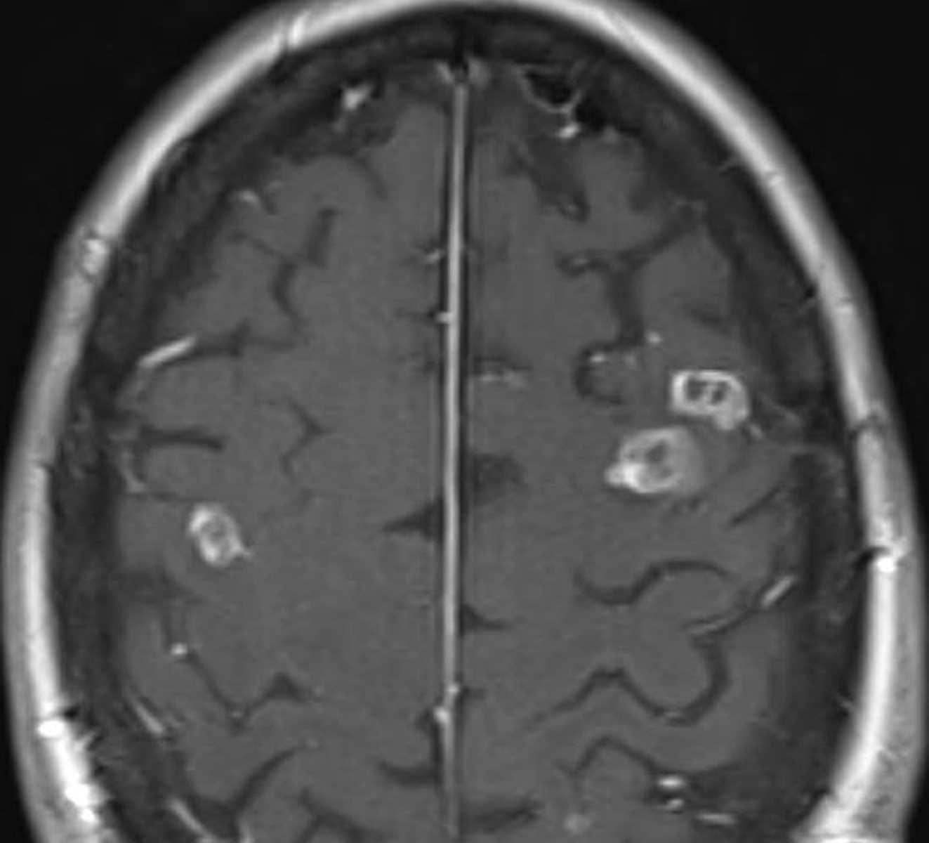 Septic Emboli - CTisus CT Scan