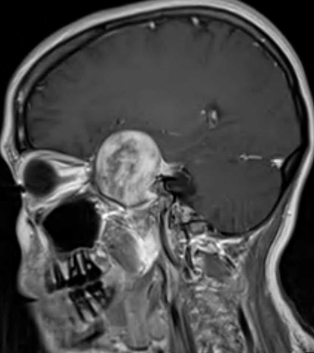 Chondrosarcoma - CTisus CT Scan