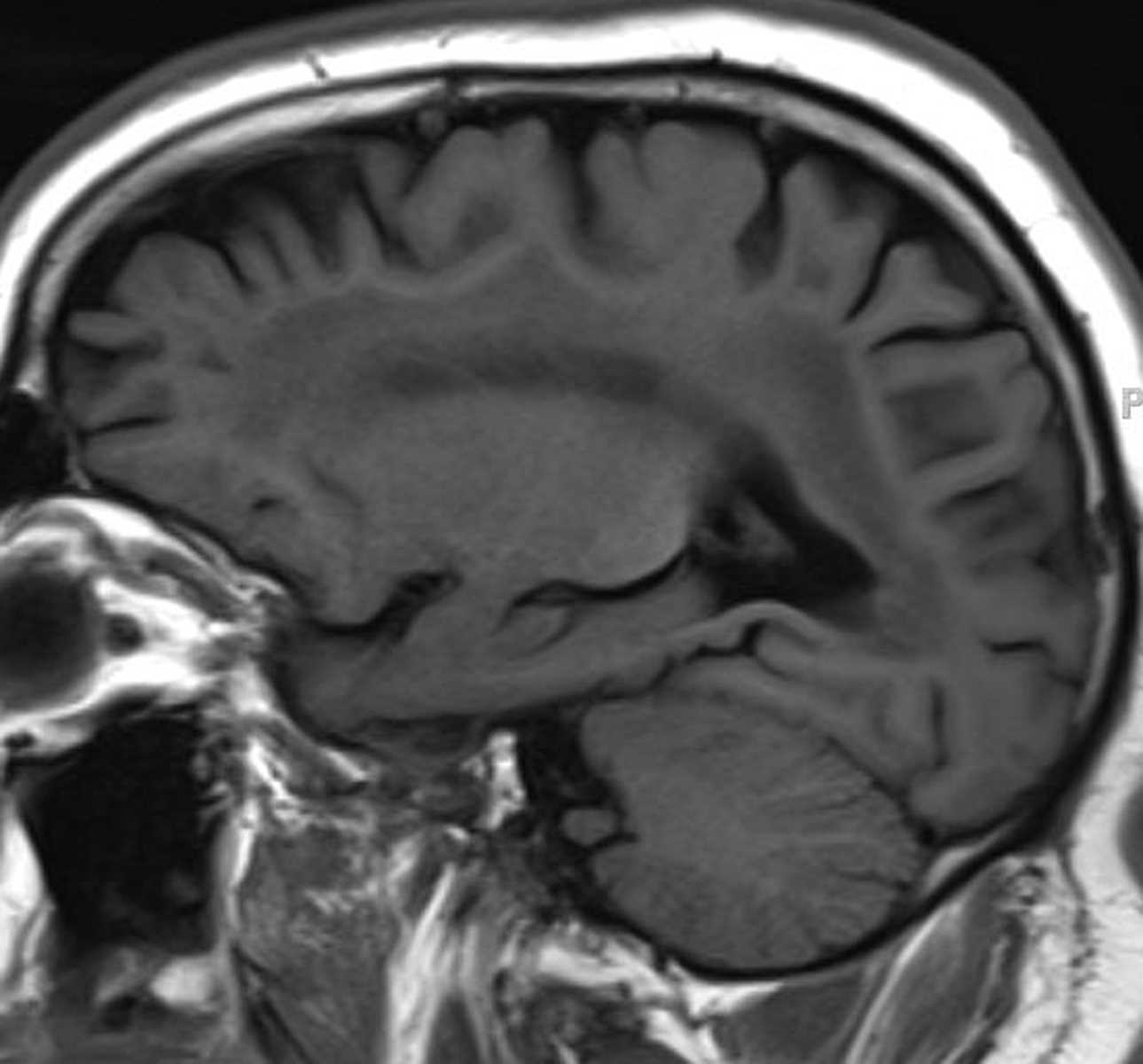 HIV Leukoencephalopathy - CTisus CT Scan