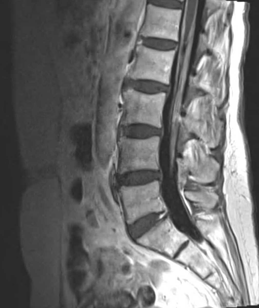 Leptomeningeal Carcinomatosis - CTisus CT Scan