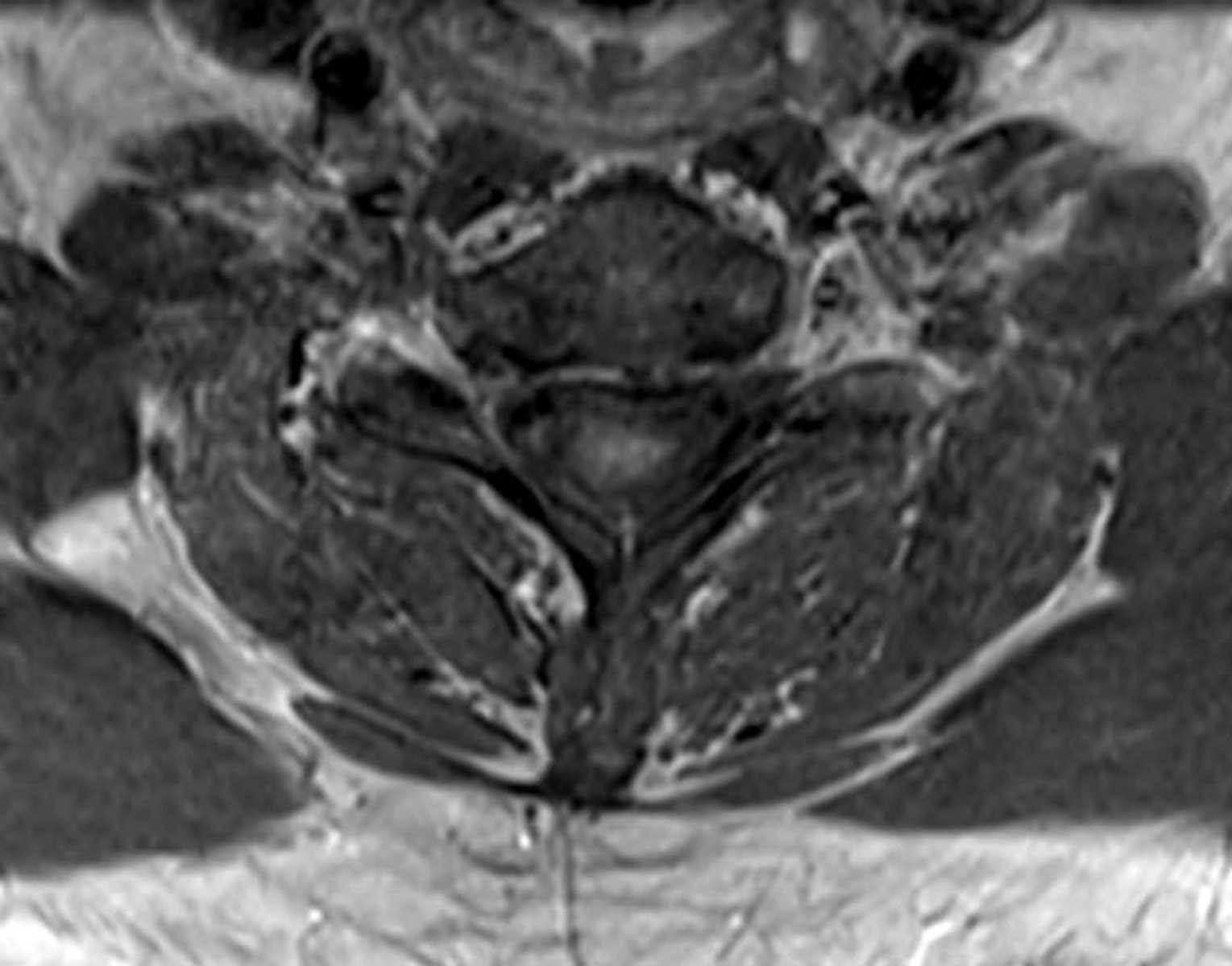 Spinal Ependymoma - CTisus CT Scan