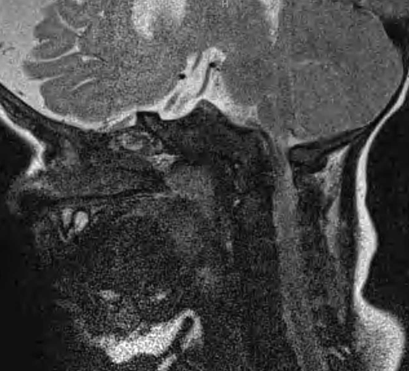 Achondroplasia - CTisus CT Scan