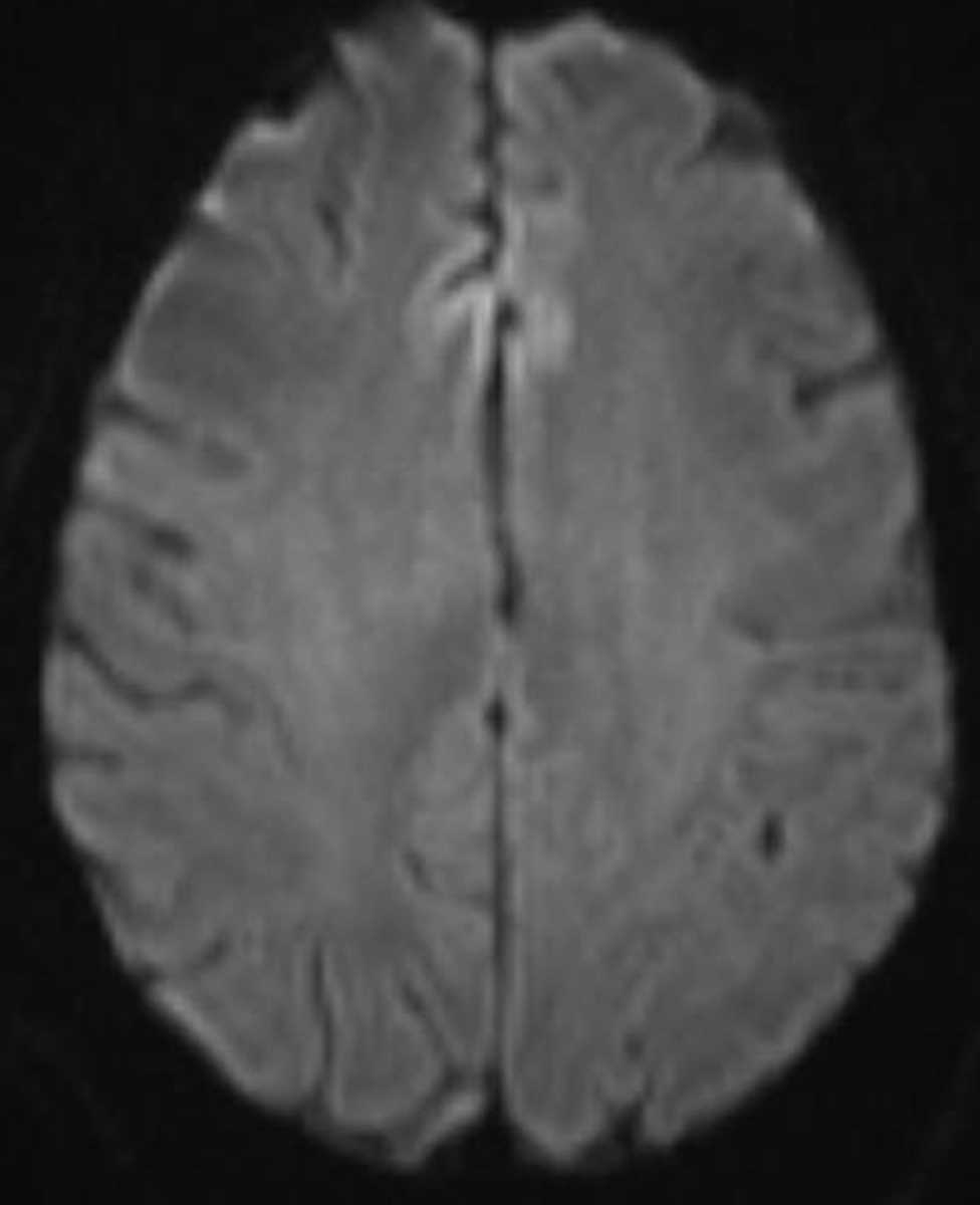 Creutzfeldt-Jakob Disease - CTisus CT Scan