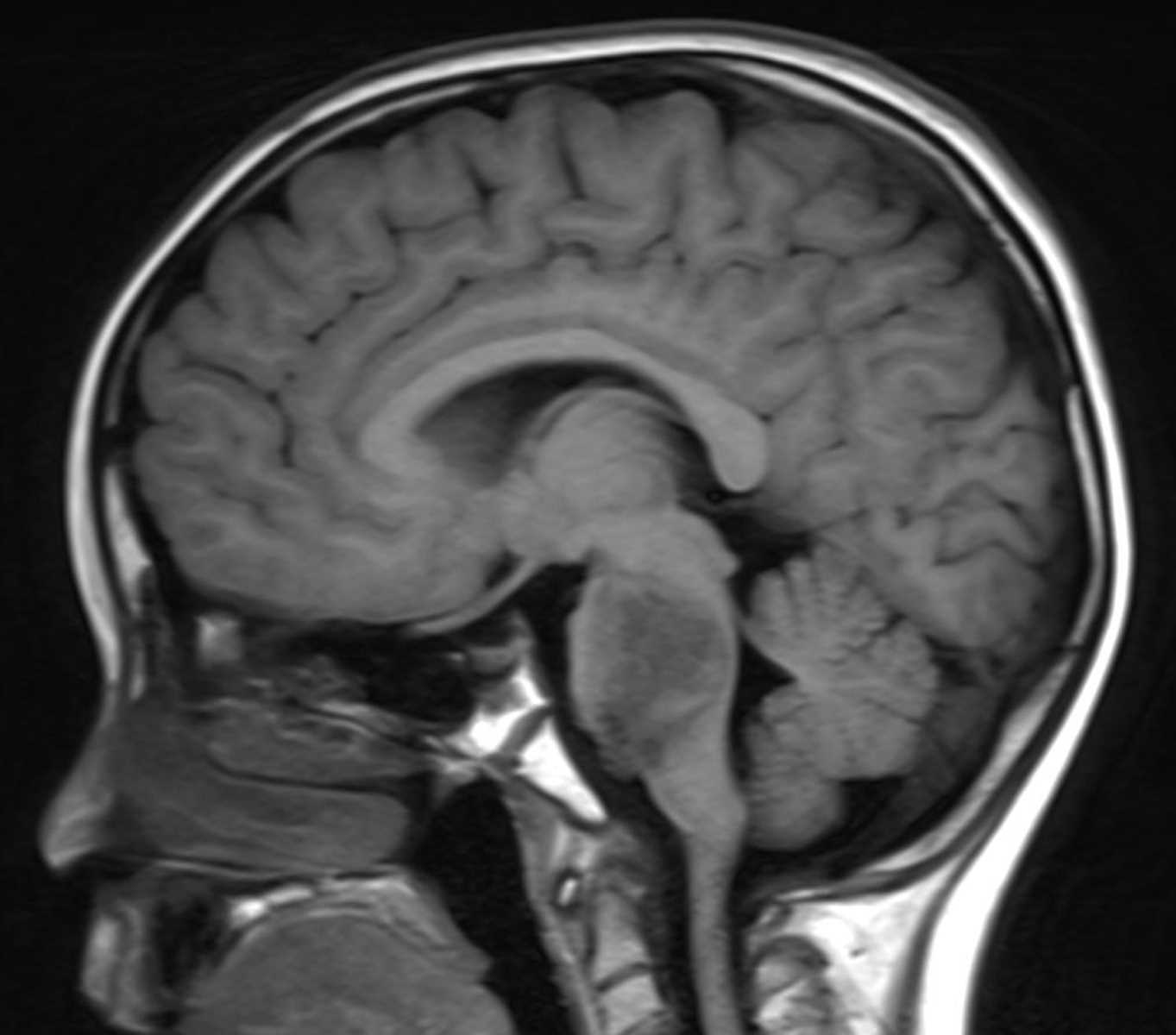 Diffuse Intrinsic Pontine Glioma - CTisus CT Scan