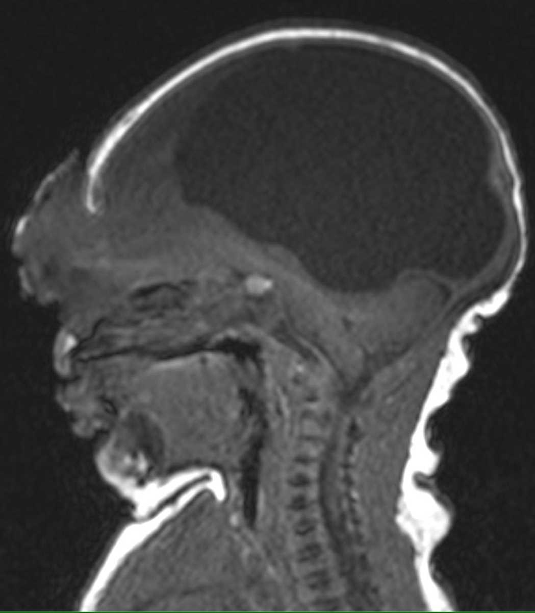 Encephalocele - CTisus CT Scan